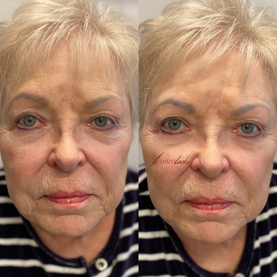 Best Botox Studio in Frisco, Texas