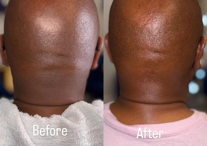 Scalp Treatment Results